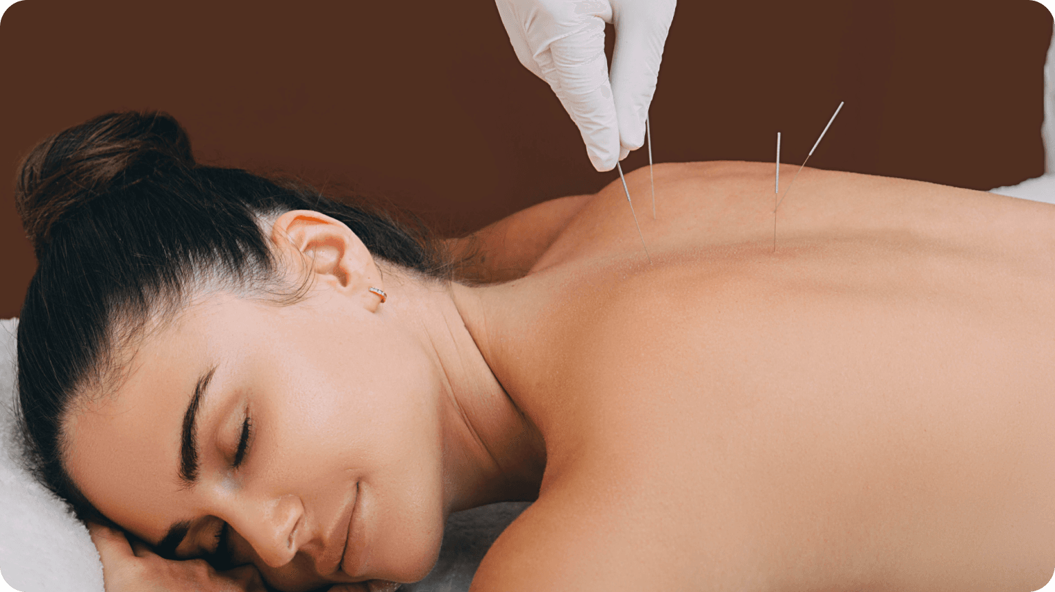 Woman being undergoing acupuncture treatment